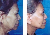 Facelift
