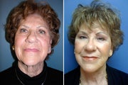 Facelift and periorbital Fat Transfer