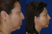 Facelift