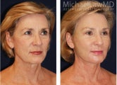 Full Facial Rejuvenation
