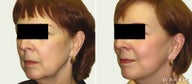 Facelift