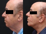 Facelift