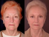 Composite facelift, midface lift, upper and lower blepharoplasty, browlift and ptosis repair