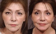 Facelift