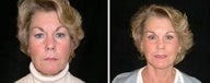 Facelift