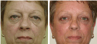 Facelift