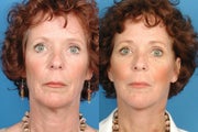 Facelift