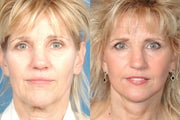 Facelift