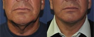 Facelift