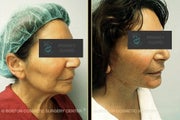 Facelift