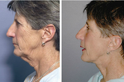 Facelift