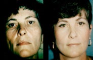 Facelift