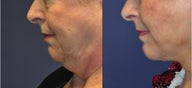Facelift