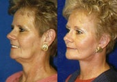 Facelift