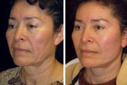 51 Year old female facelift