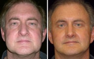 55 year old male, facelift