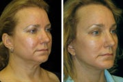 52 year old woman facelift