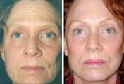 52 year old woman facelift