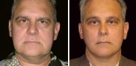 54 year old male, facelift