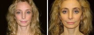 52 year old female, facelift