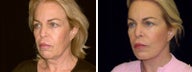 59 year old female, facelift