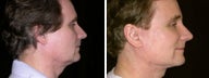 50 year old male, facelift