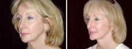 47 year old female, facelift
