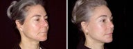 42 year old female, facelift