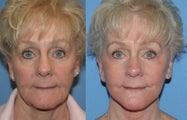 Facelift
