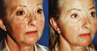 Facelift