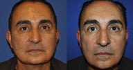 Facelift