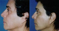 Facelift