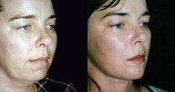 Facelift