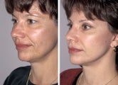 Facelift