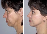 Facelift