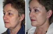 Face and neck lift side view