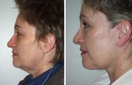 Face and neck lift side view