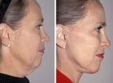 Side face and neck view after face lift