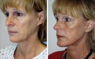 Face lift with dermabrasion side view