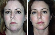 Face Lift and Brow Lift