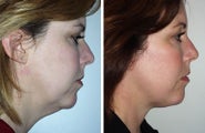 Face Lift and Brow Lift
