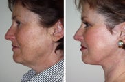 Side view of face lift