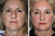 Frontal view of a face lift