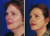 Face and necklift, Superficial cheeklift, CO2 laser resurfacing