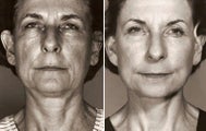 Facelift
