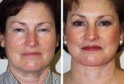 Facelift