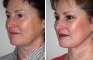 Facelift