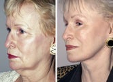 Facelift