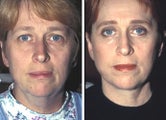 Facelift