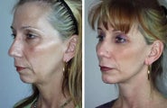 Facelift and Chin Implant